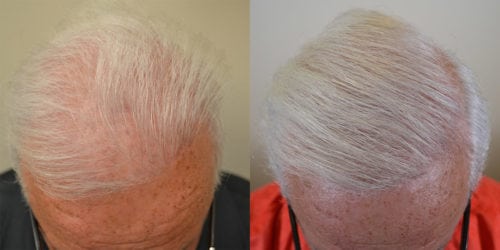 Patient is 71 year old male with previous hair transplantation over 20 years ago. He wanted more density and to lower left frontal hairline. FUE and Strip harvest methods both used.