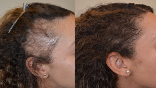 Before and only 4 months post op. 1400 grafts transplanted.