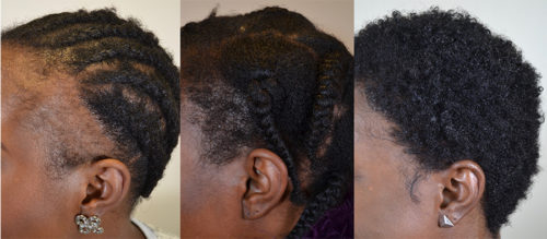 Traction-Alopecia-Left