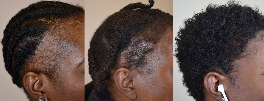 Hair Transplant Before and After Photos: African-Americans - Hair