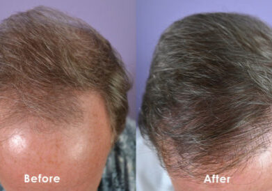 Before and 12 months post-op. Frontal hairline and anterior vertex treated.
