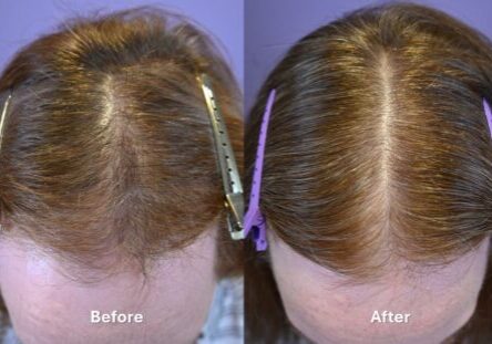 Before and 3 years after combination medical hair loss therapy