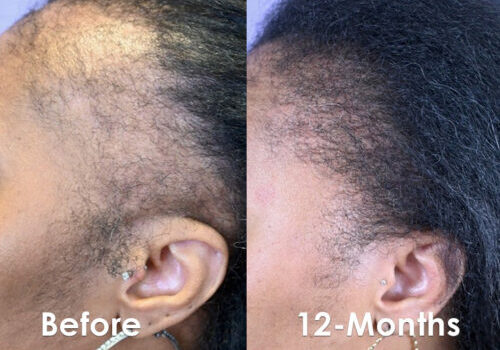 Before and 12 months after FUT hair transplant