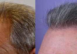 Forelock-Left