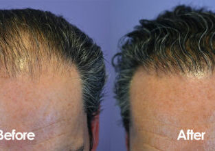 NW 4, 1439 grafts, FUT 