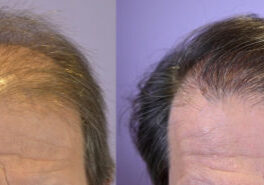 Front view of a soft, natural hairline, creating a gradual transition to fuller hair.