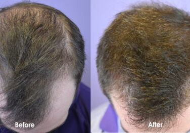 Before and After 18 months on low dose oral minoxidil.