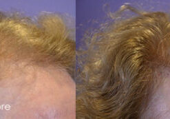 Right-Side-Female Hairline-Restoration