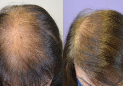 Top view before and after medical therapy and FUT hair transplant.