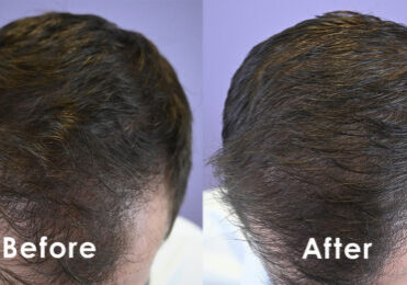 Top view before and one year post FUE hair transplant.