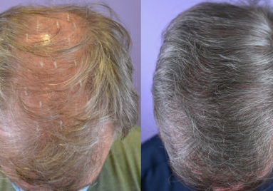Before and 1 year after  FUR hair transplant - Top view.