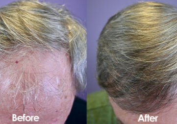 NW4, 1529 grafts, FUT