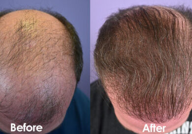 Top view, before and 12 months after FUT hair transplant.