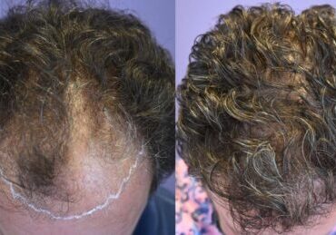 1505 FUE Hair Transplant - NW4