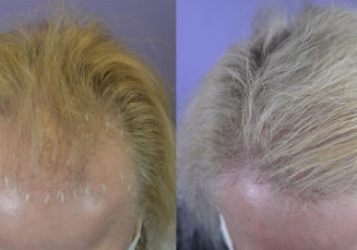 Top view. This 70 year old had severe male patter hair loss in the front and temporal region. After photo 1 year post-op.
